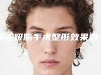 眼皮吸脂手术整形效果到底怎么样