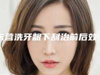 东营洗牙龈下刮治前后效果图,东营洗牙龈下刮治修复术后效果