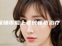 深圳市脸上老长痤疮治疗价格表(费用)详细信息曝出-深圳市脸上老长痤疮治疗好不好，费用贵不贵