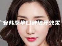 广安韩系半口种植牙效果更明显