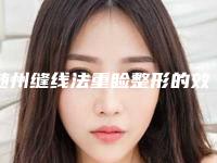 随州缝线法重睑整形的效果及价格_随州缝线法重睑手术大致要多少钱