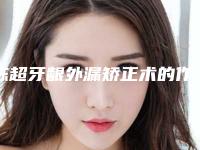 陈超牙龈外漏矫正术的作用持续时间是多久