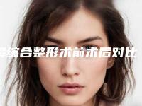 鼻综合整形术前术后对比图（鼻综合手术前后）